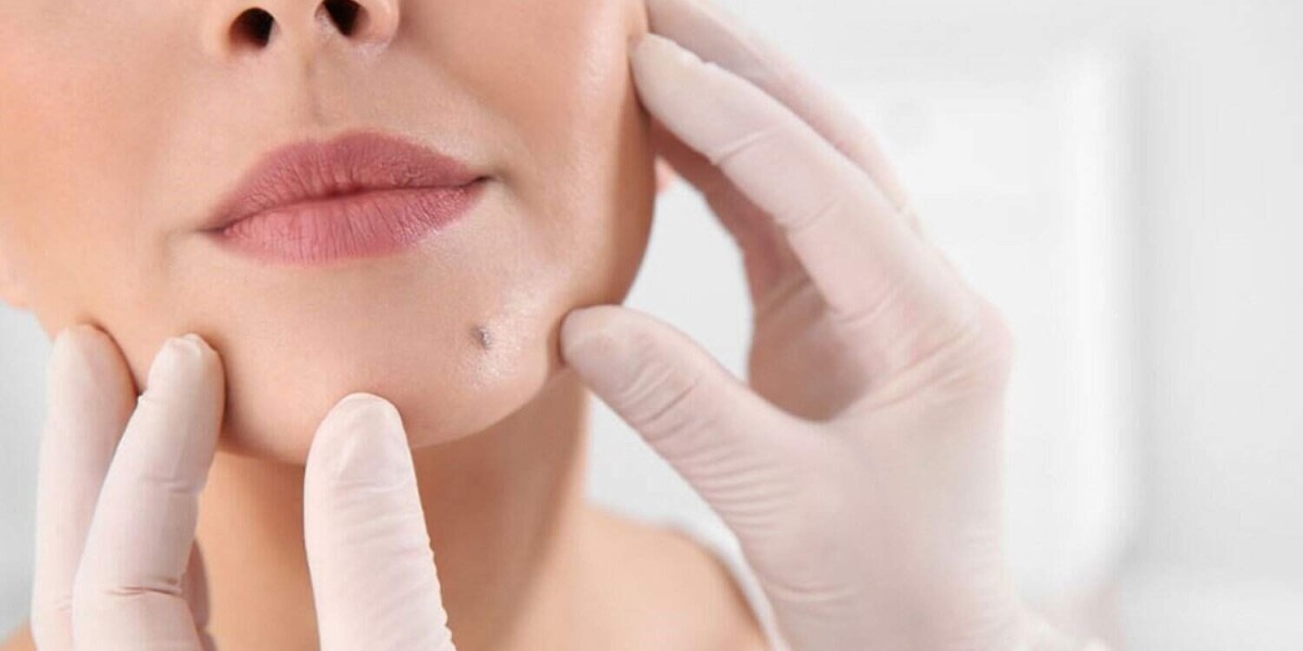 Who Is an Ideal Candidate for Mole Removal in Islamabad?