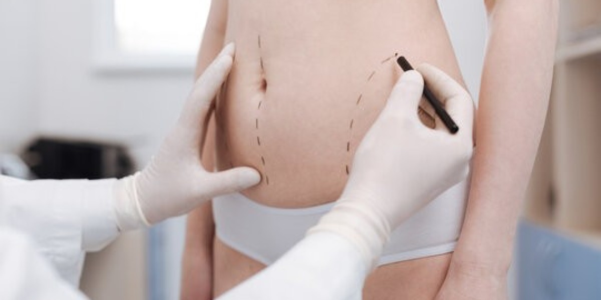 Mini-Liposuction Riyadh: Targeted Fat Removal for Small Areas