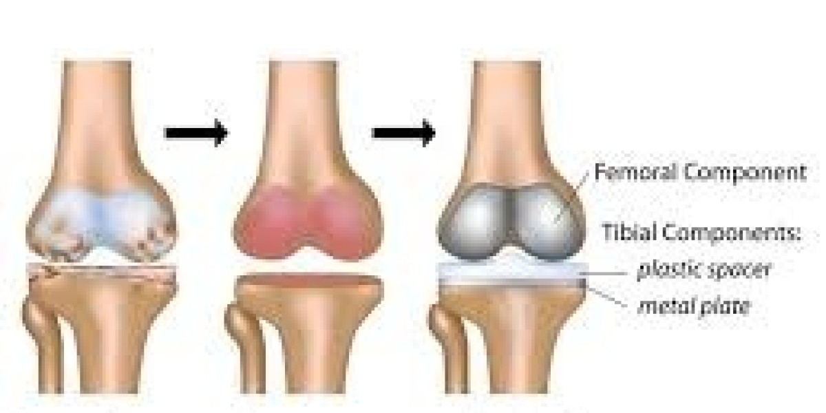 Private Knee Replacement Surgery BC: Fast-Track Care, Costs, and What to Expect