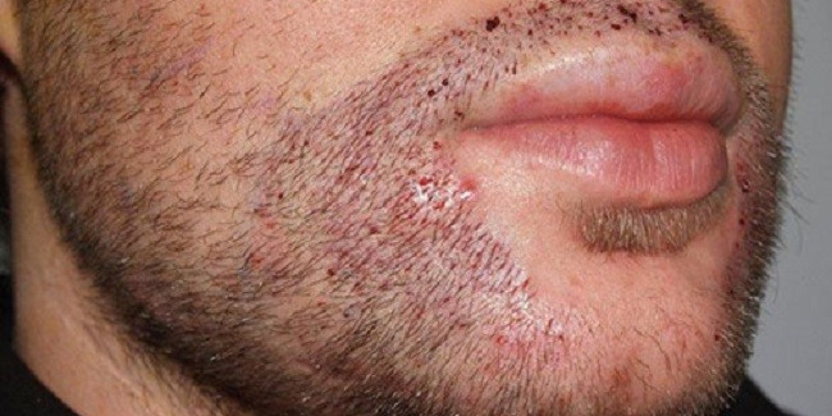 Mustache Hair Transplant with Robotic Assistance