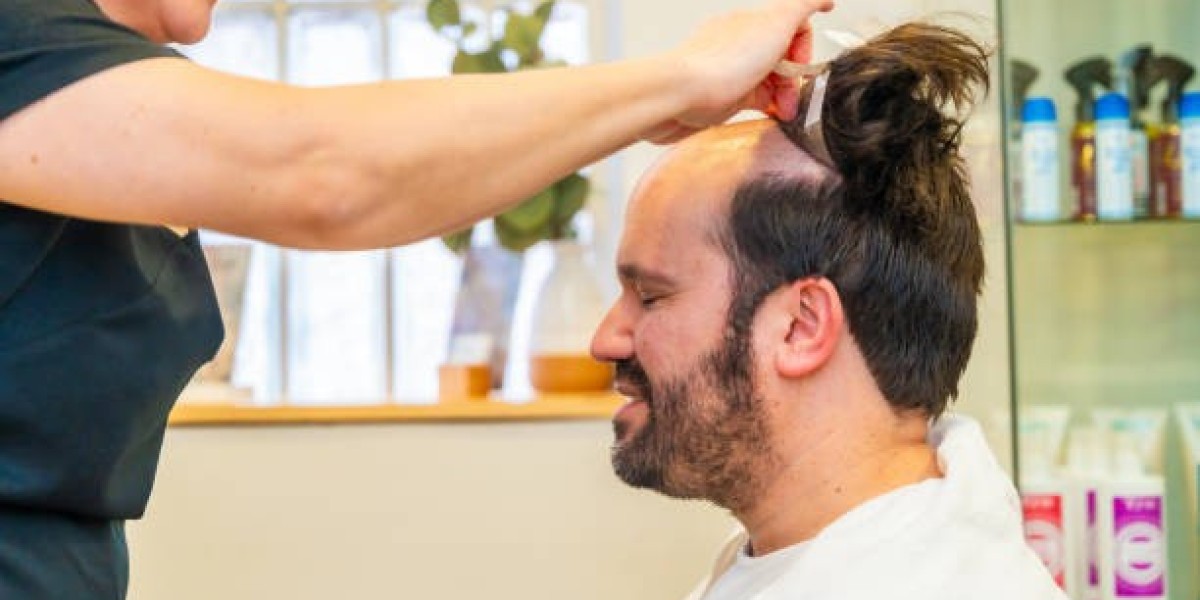 From Thinning to Thriving: Real Hair Transplant Success Tales