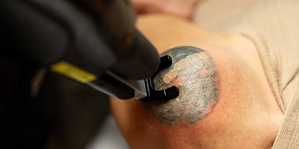 Top Clinics for Tattoo Removal in Dubai: What to Expect