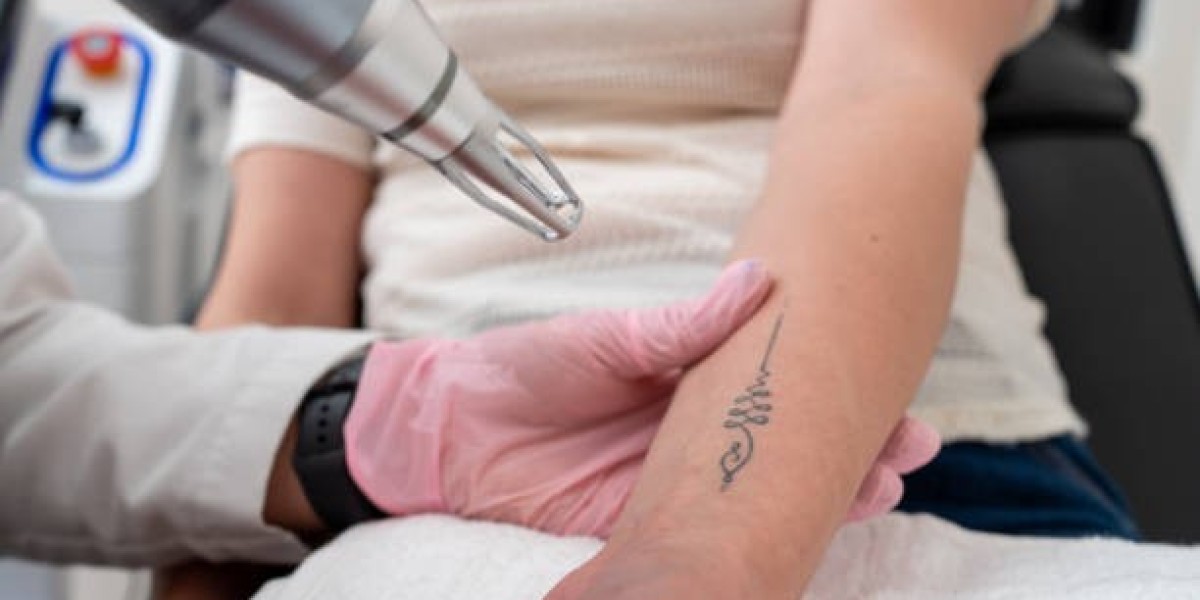 Laser Tattoo Removal for Facial and Body Tattoos