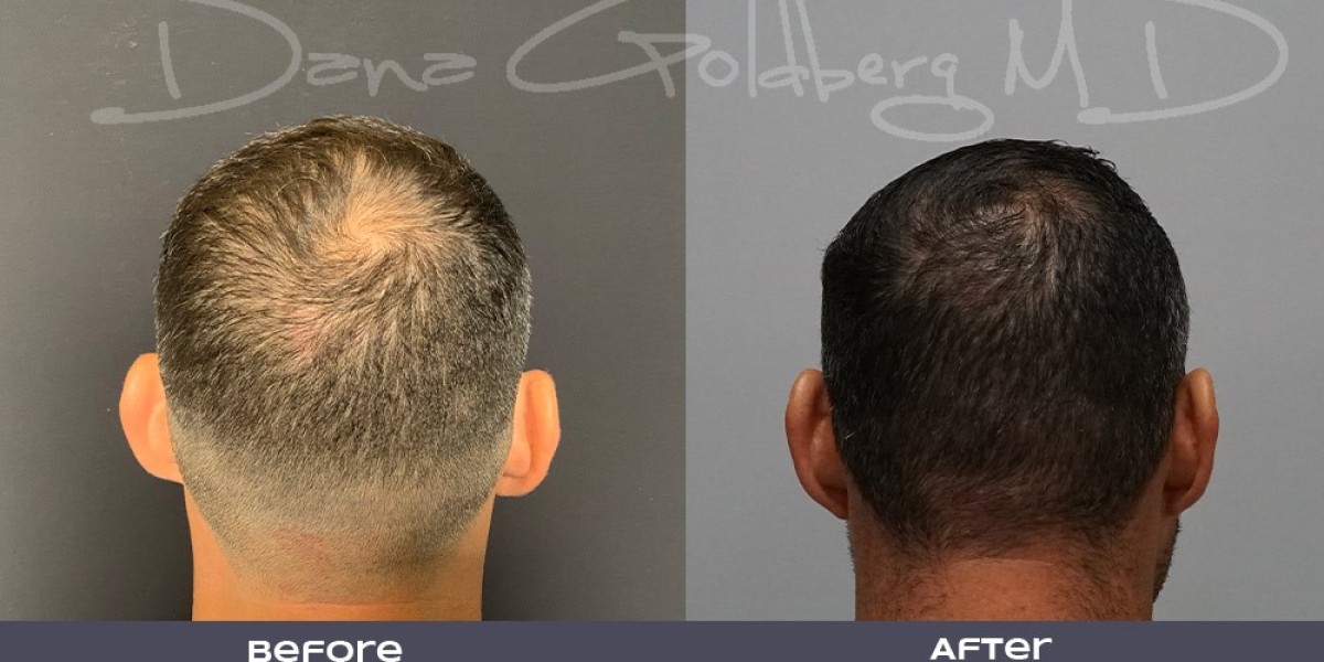 تكلفة زراعة الشعر في الدمام والعوامل المؤثرة