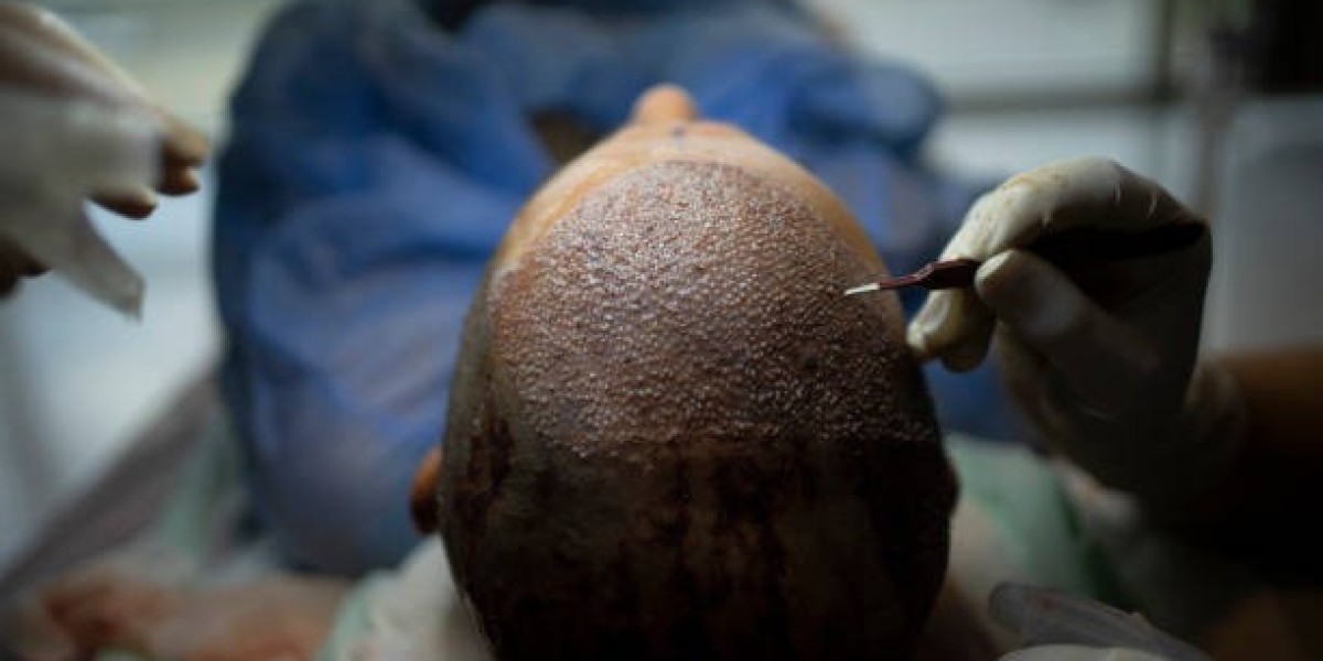 Hair Transplant Cost in Dubai: Low vs. High-End Clinics Explained