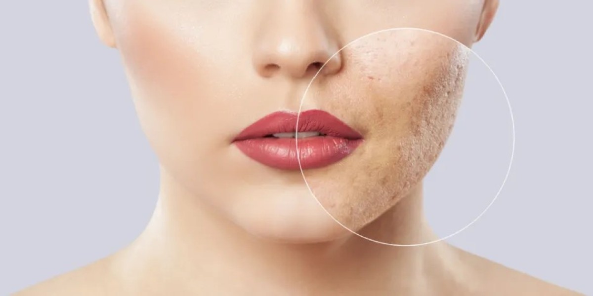 Acne Scar Treatments Dubai: Latest Innovations