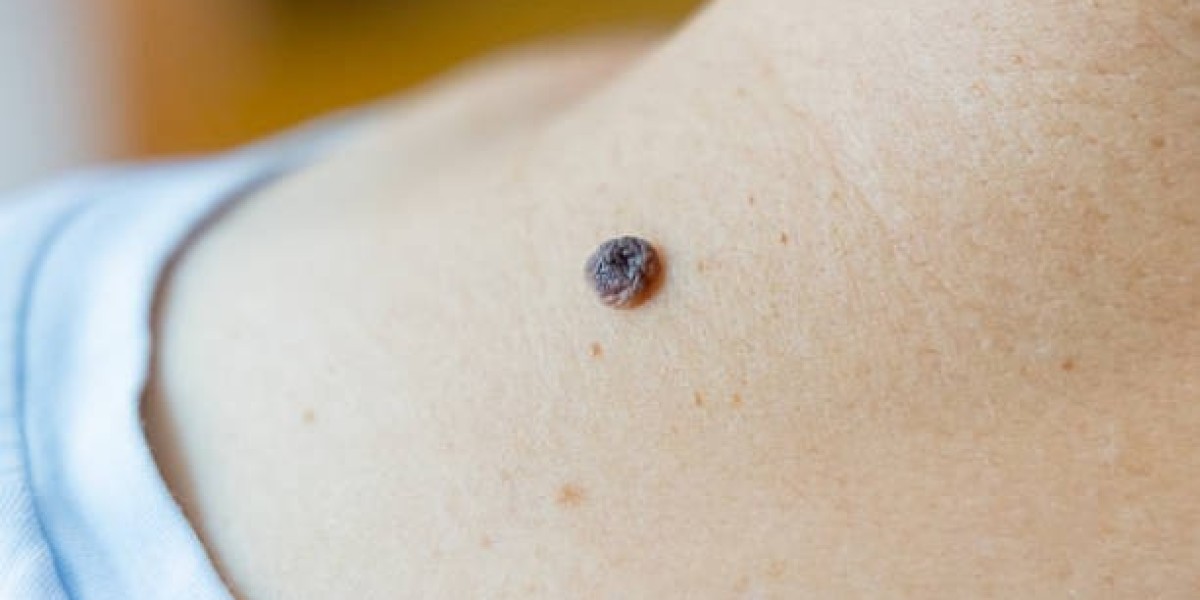 Trusted Clinics for Birth Mark Treatments in Dubai