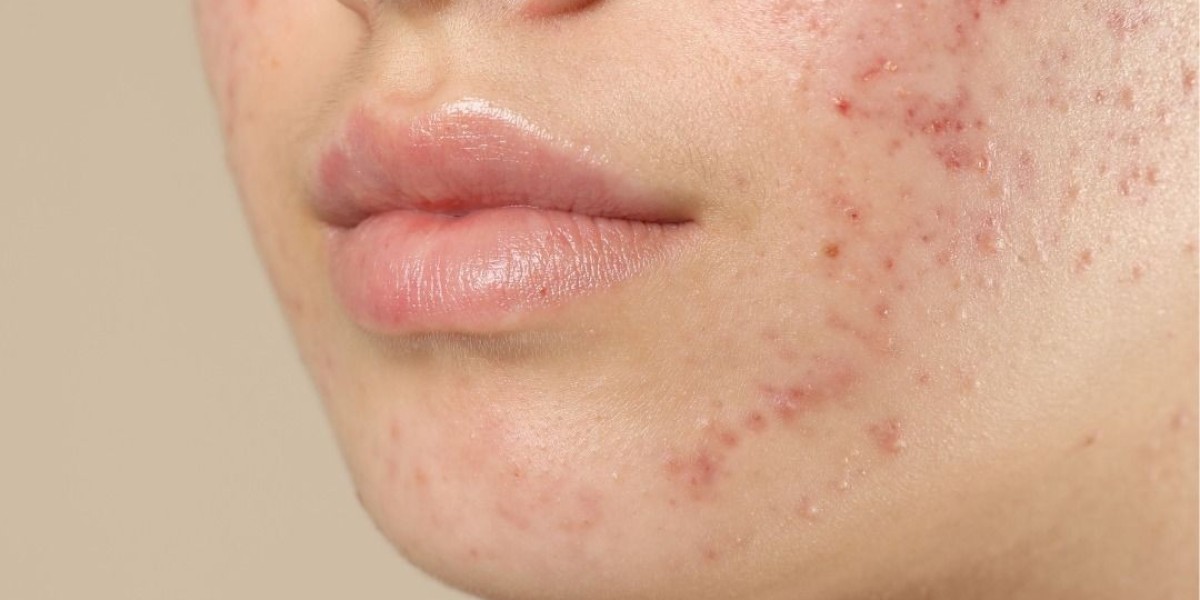 Customized Acne Solutions for Every Skin Type in Riyadh