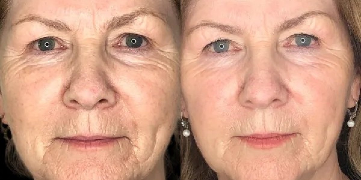 Best Aesthetic Clinic in Dubai Enhancing Skin Quality with Profhilo