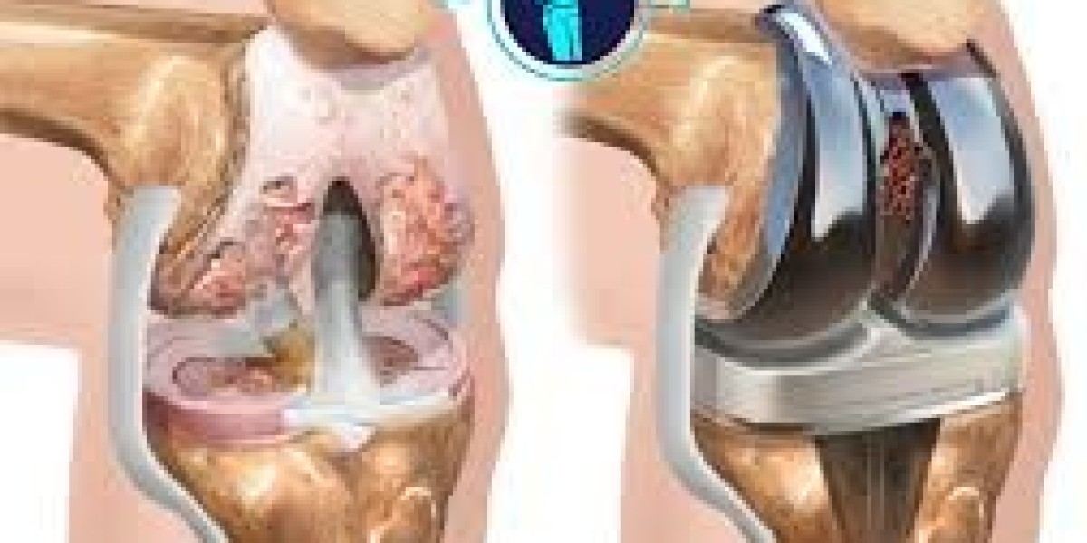 Cost of Private Knee Replacement Surgery in BC: Pricing & Options