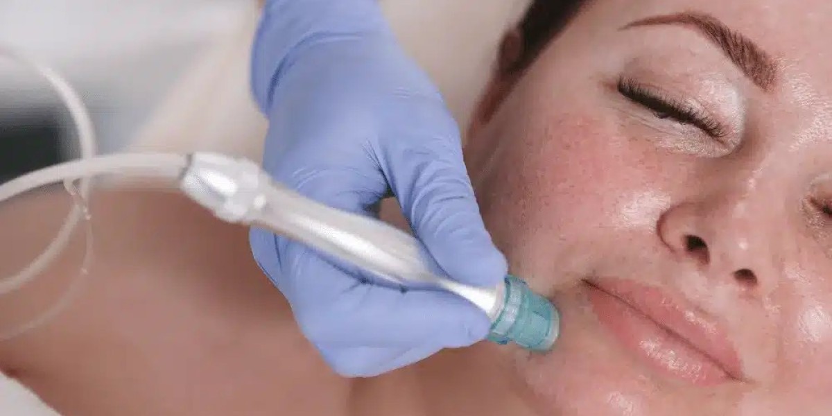 Laser vs. Microneedling: Choosing the Best Option for Pores