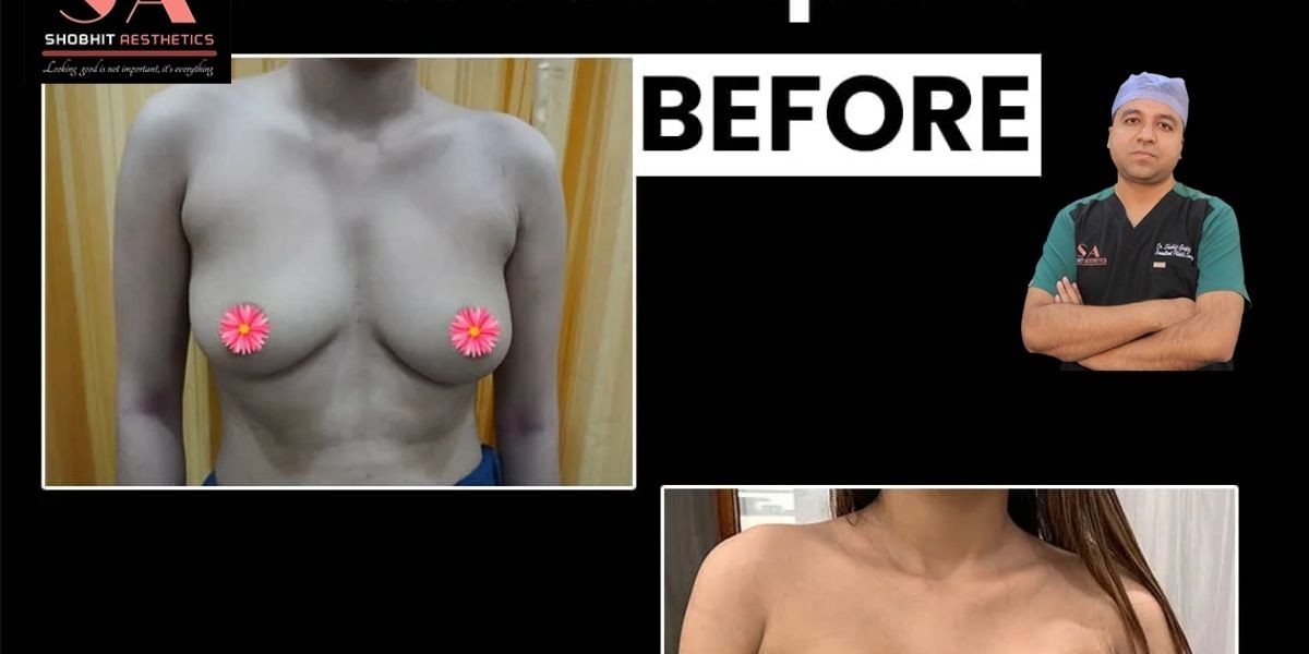 Breast Augmentation Surgery in Delhi: A Complete Guide
