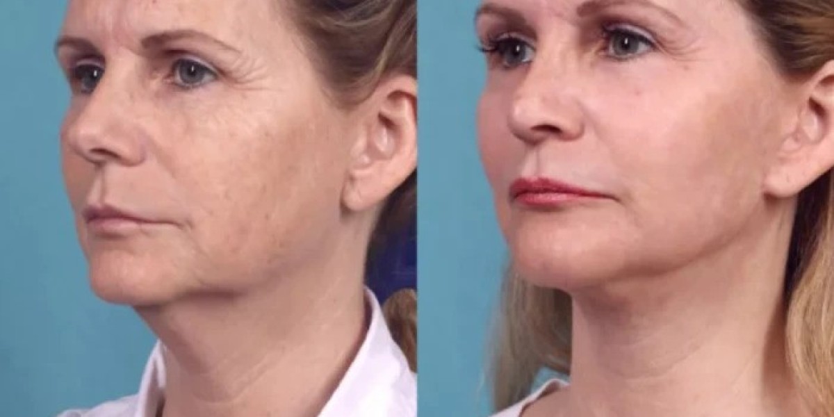 Best Plastic Surgeons in Dubai for Chemical Peel Skin Correction