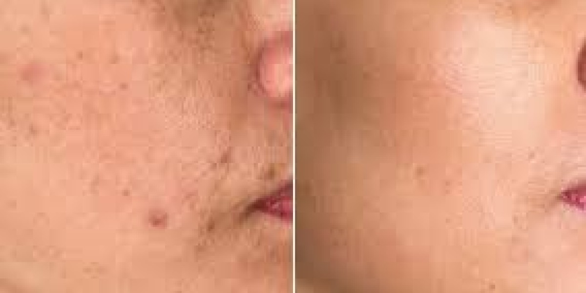 Best Treatment for Hyperpigmentation Safe, Effective & Long-Lasting Skin Solutions