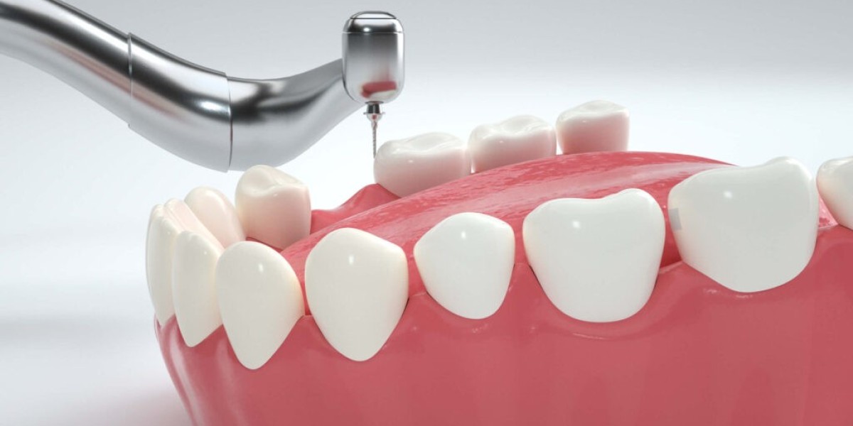 Tooth Removal for Orthodontic Treatment