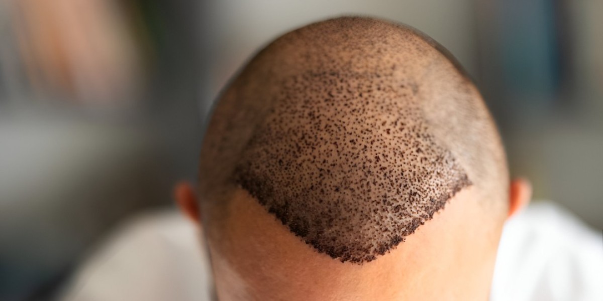 Understanding Graft Density in Hair Transplant in Islamabad