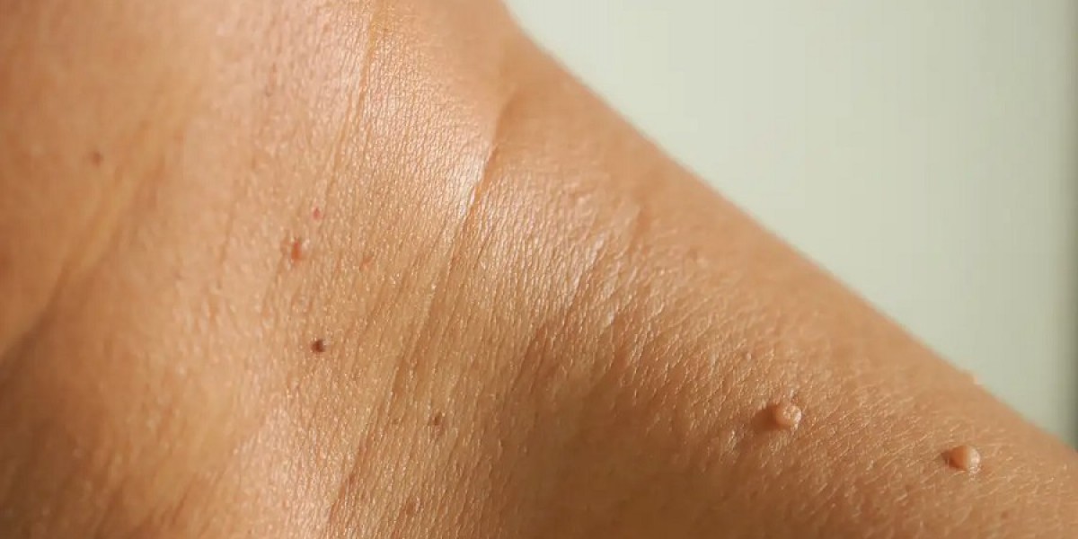 Complete Guide to Skin Tag Removal in Dubai Techniques