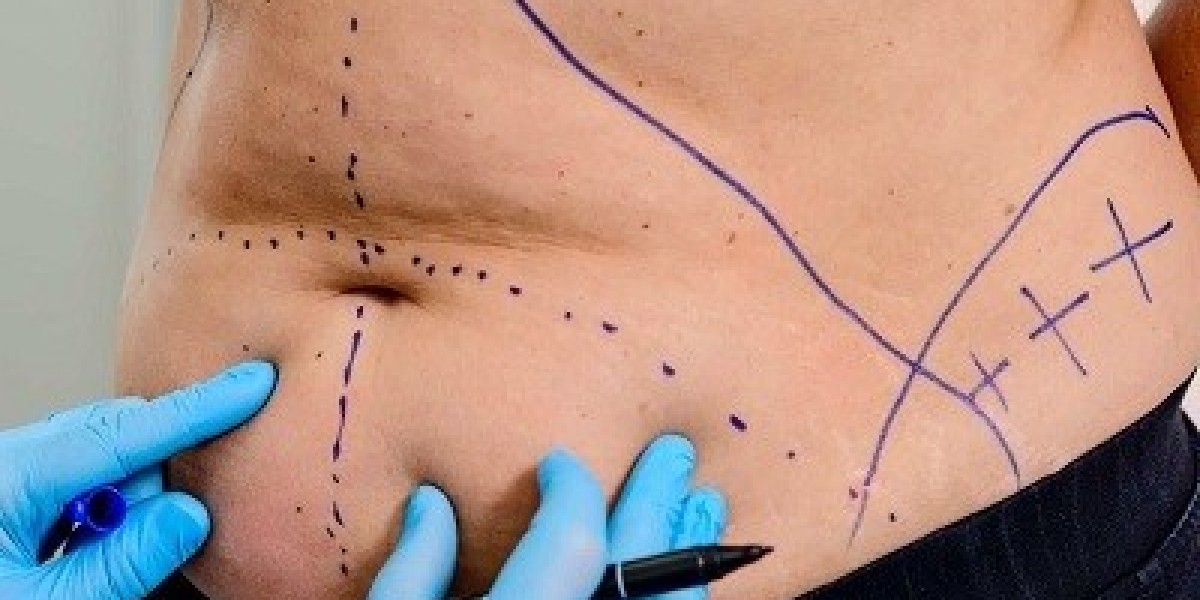 Liposuction in Riyadh Personalized Body Care