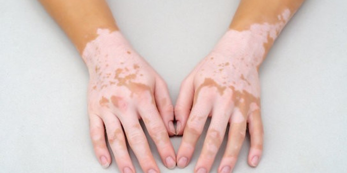 Proven Vitiligo Treatment in Islamabad – Before and After Results