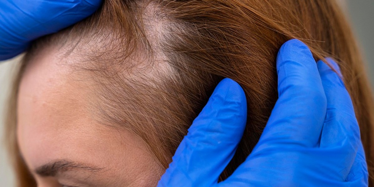 Restore Lost Hair Elegantly with Hair Transplant in Dubai Advanced Techniques