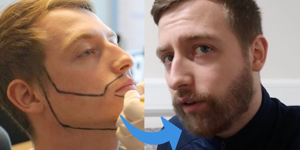 خبراء زراعة شعر اللحية في الرياض