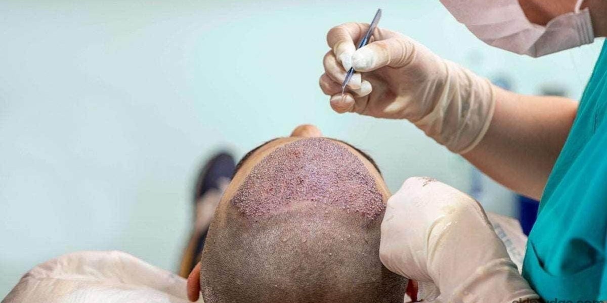 Can Women Get a Hair Transplant?