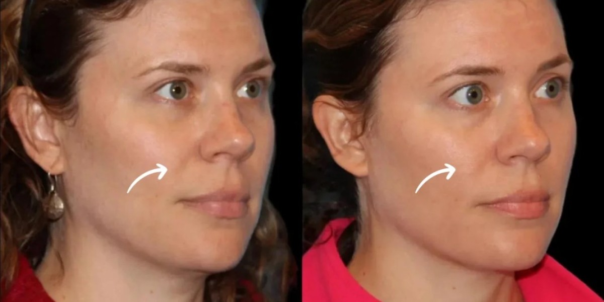 Best Plastic Surgeons in Dubai: Sculptra Fillers Cheek Contouring