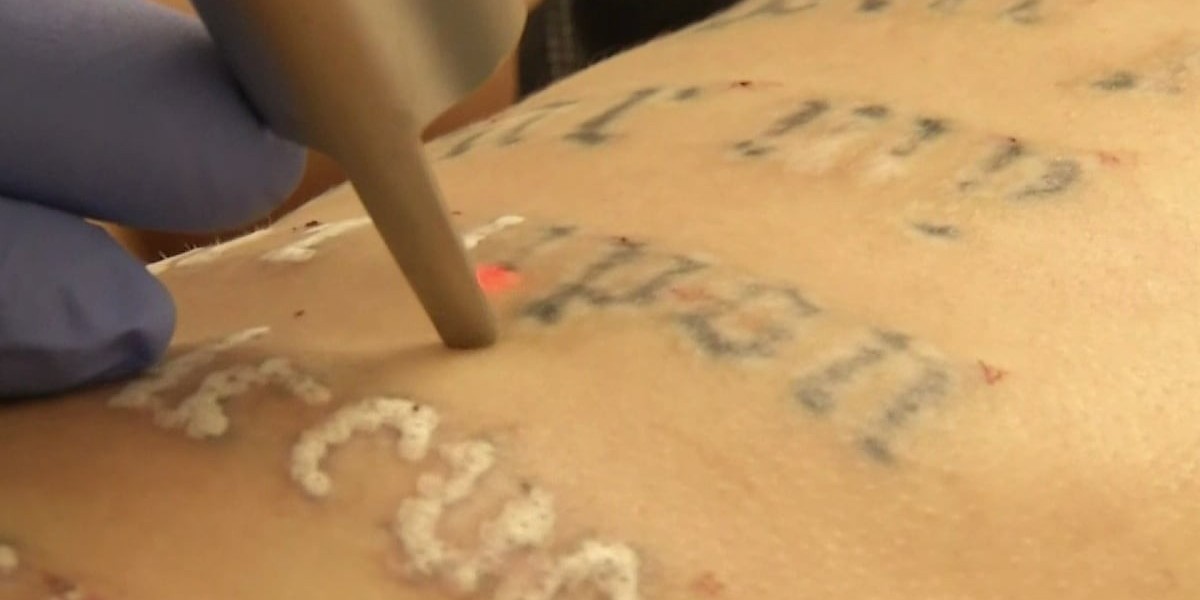 Laser Tattoo Removal Process Explained Step by Step