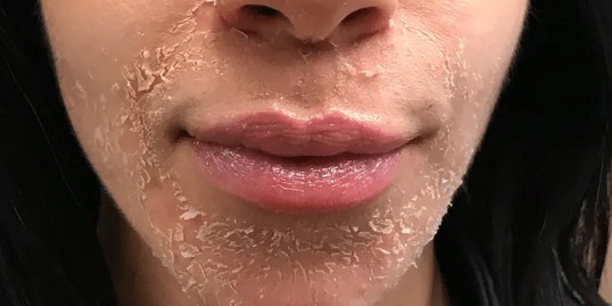 Dubai Chemical Peels: Skin Transformation Secrets