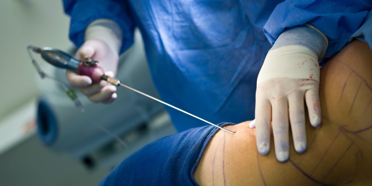 Liposuction for Thighs, Arms, and Chin: Area-Wise Benefits