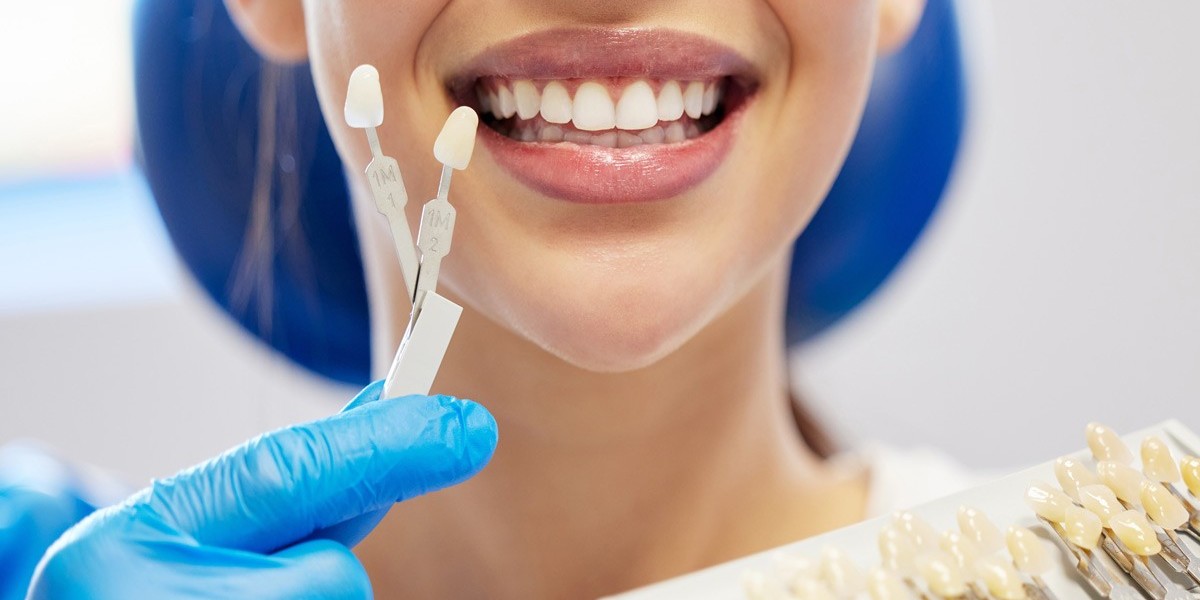 E-max Veneers in Dubai: Improve Smile Aesthetics