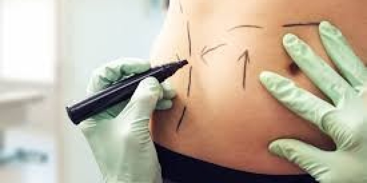 What Are the Risks of Liposuction in Islamabad You Should Know?