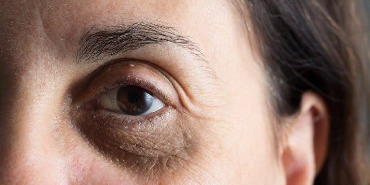 Natural Remedies For Dark Circles Treatment In Dubai