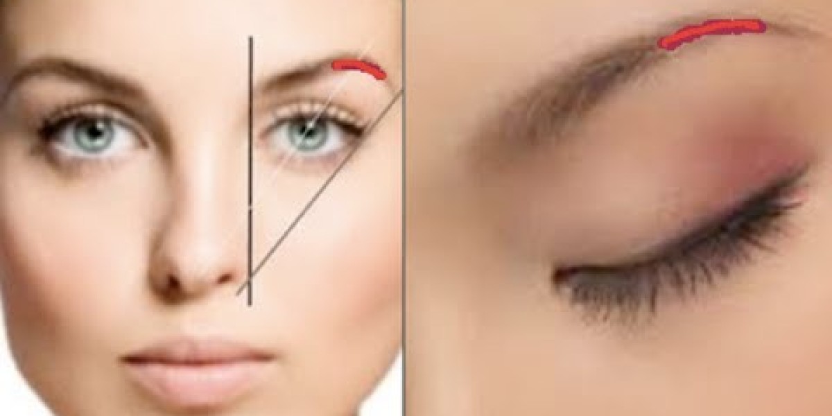 عملية رفع الحاجب في الرياض للتخلص من ترهل الحاجب