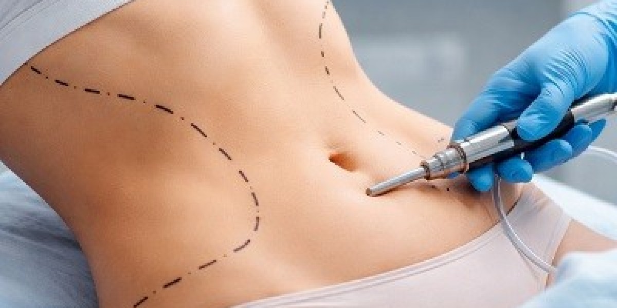 What Is Liposuction Surgery? A Complete Guide
