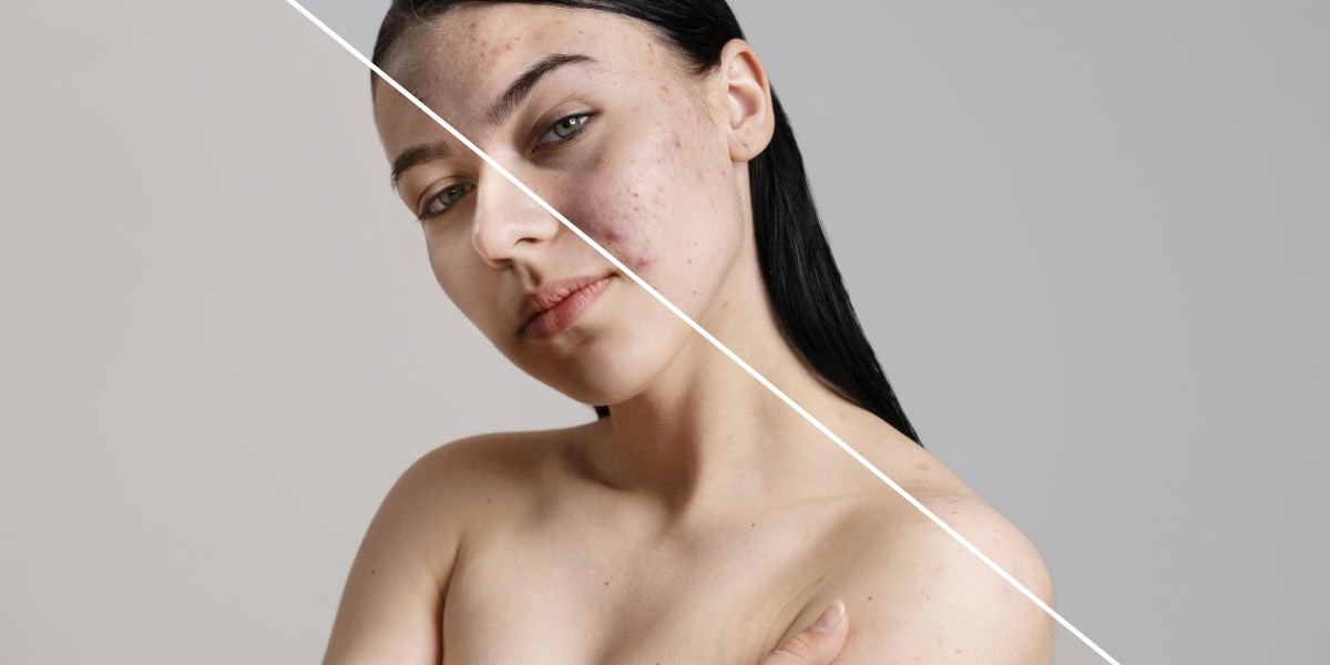 Why Treating Acne Early Can Help Prevent Scarring