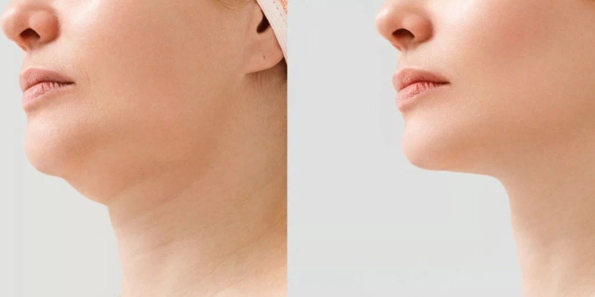 How Long Does It Take to See Results From Double Chin Removal in Islamabad?