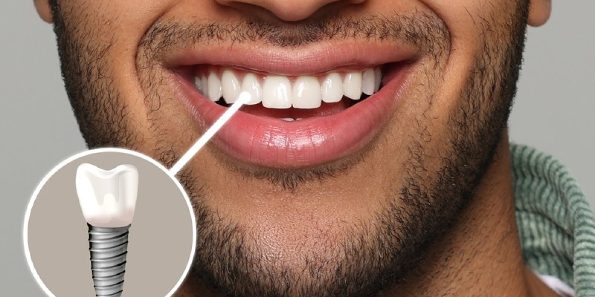 Why Are Dental Implants in Dubai Changing Dental Care Trends