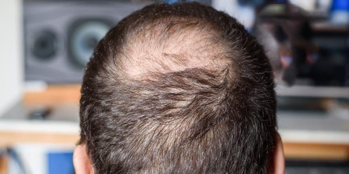 Crown Hair Transplant Dubai Advanced Techniques