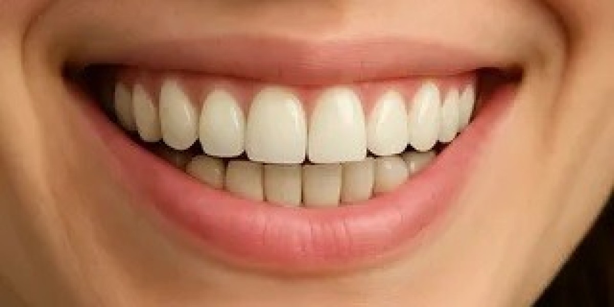 How Often Should You Get Teeth Whitening in Islamabad?