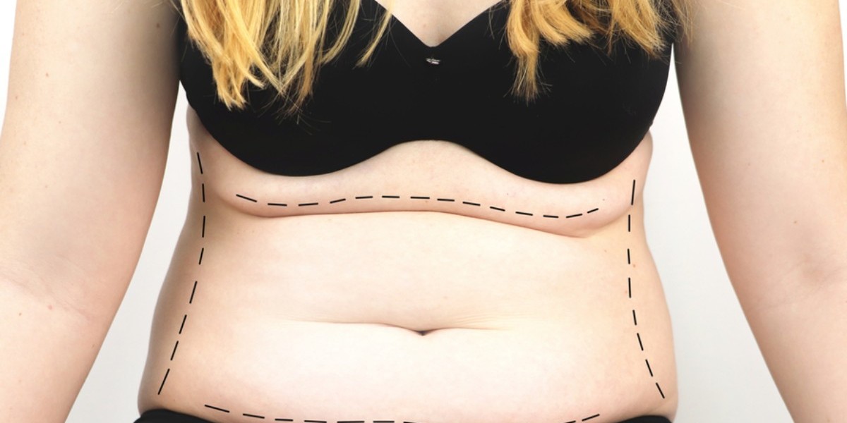 BodyTite Liposuction: A Complete Guide for First-Time Candidates