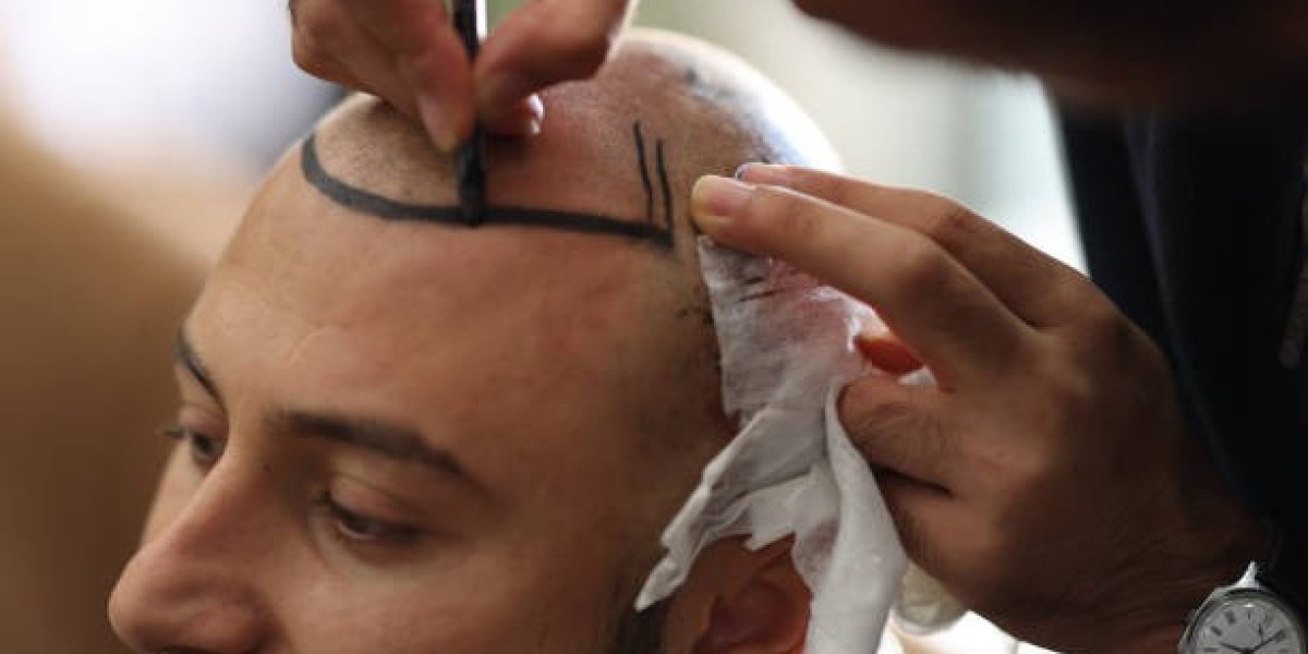 Why Patients Choose Hair Transplant in Riyadh at Royal Clinic