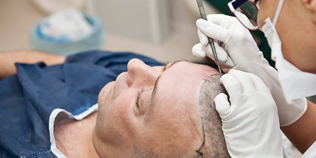 Hair Transplant Cost Guide: Smart Tips for First-Time Patients