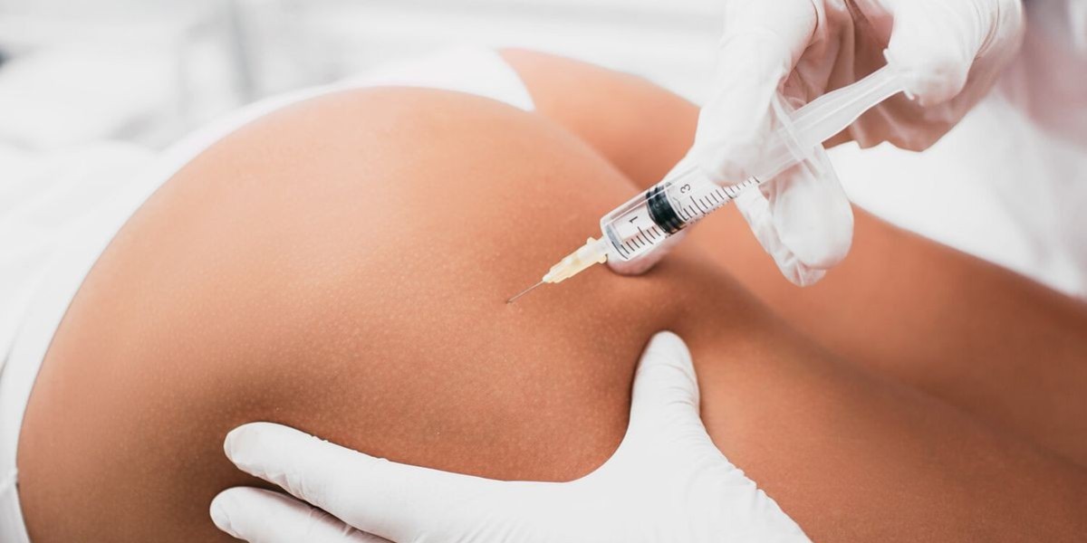 Butt Body Fillers: Redefining Body Contouring Today