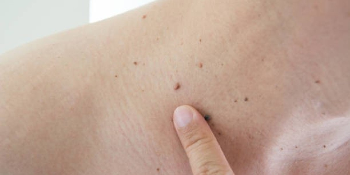 Expert Advice for Warts Removal in Dubai: What Works Best