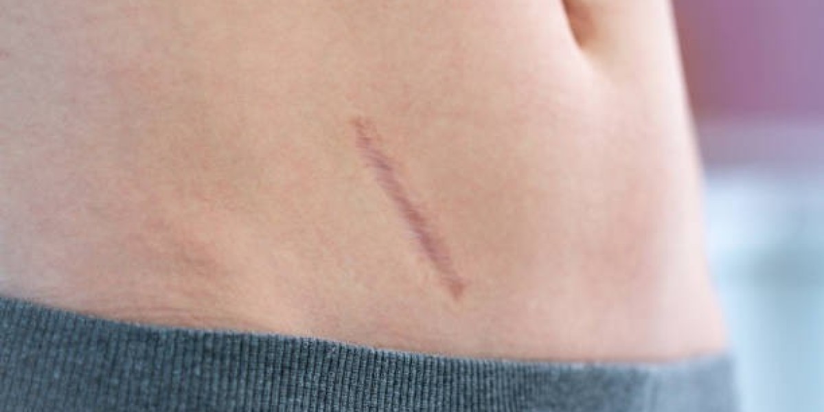 Scar Removal in Dubai: Combining Technology and Expertise for Results