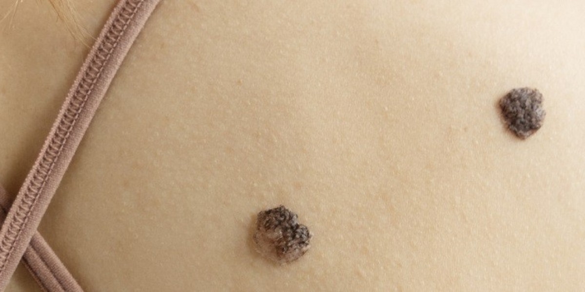 Mole Removal In Dubai: Home Care Tips