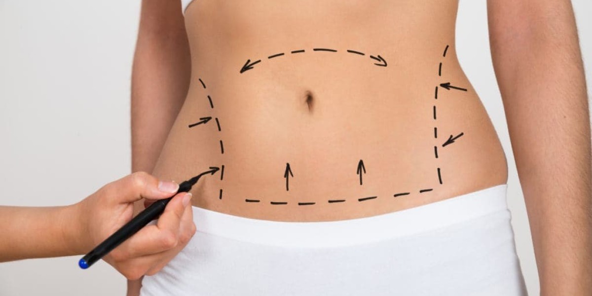 Abdominoplasty in Dubai: Combining Surgery with Healthy Lifestyle