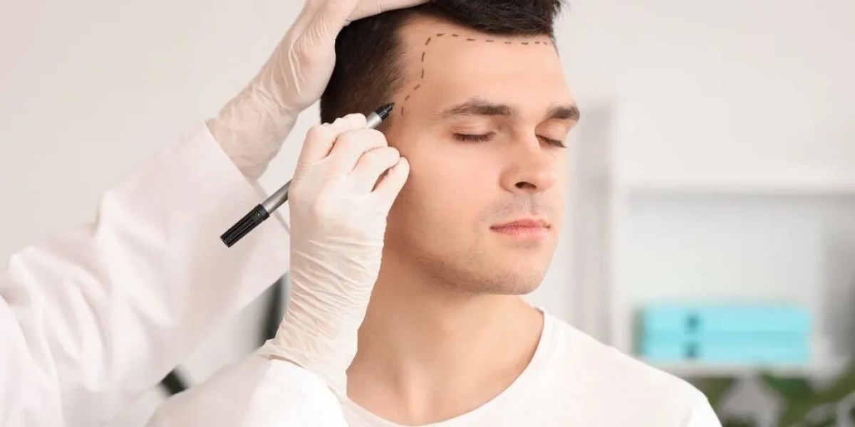 Hair Transplant and PRP Therapy Combined Benefits